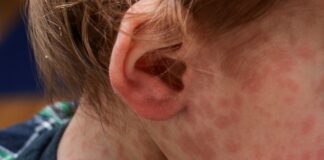 Sarampión en Entre Ríos