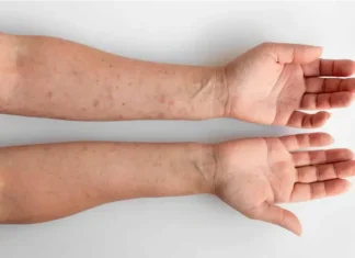 Aumentan los casos de sífilis en Argentina